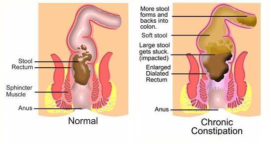 http://www.leakygutcure.com/blog/wp-content/uploads/2011/06/constipation.jpg