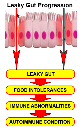 Leaky Gut Syndrome Progression